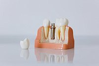 Cât de durabile sunt implanturile dentare? Așteptări vs realitate